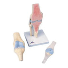Sectional model of the knee joint, in 3 parts - Anatomy and pathology